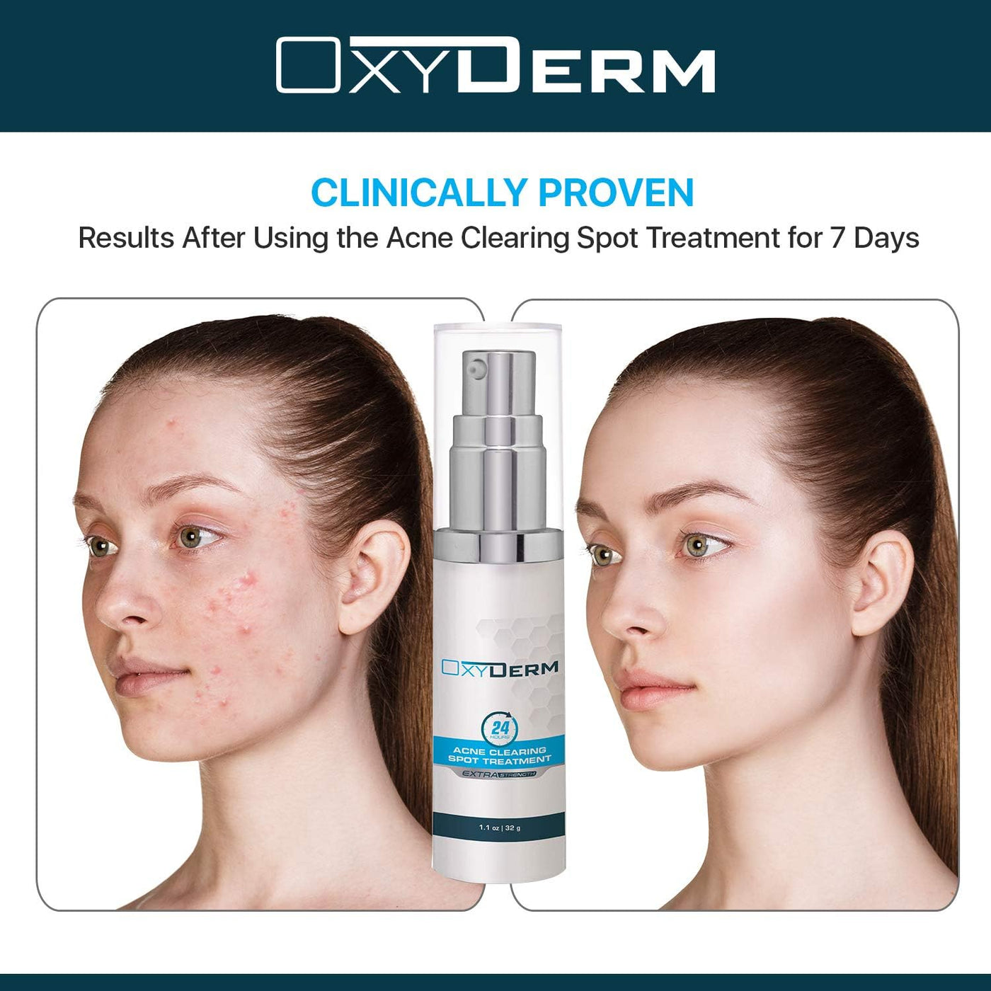 Acne Spot Treatment- Overnight Pimple Treatment for All Skin Types without Over Drying your Skin. Removal for Inflamed Blackheads, Whiteheads, Cystic Acne. Results within Hours for Adults & Teens.